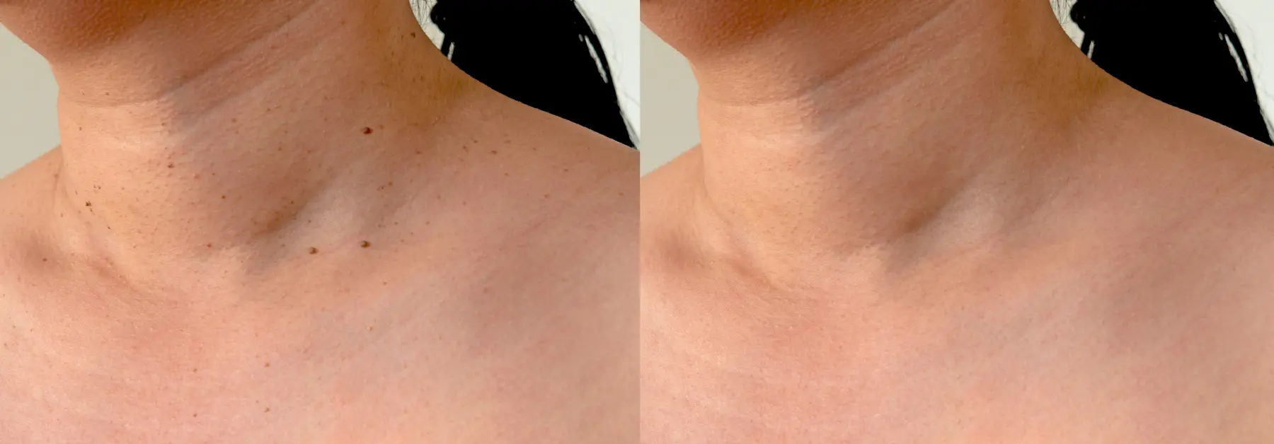 onetec® Hautbildverbesserung in Sekunden – testen Sie es!