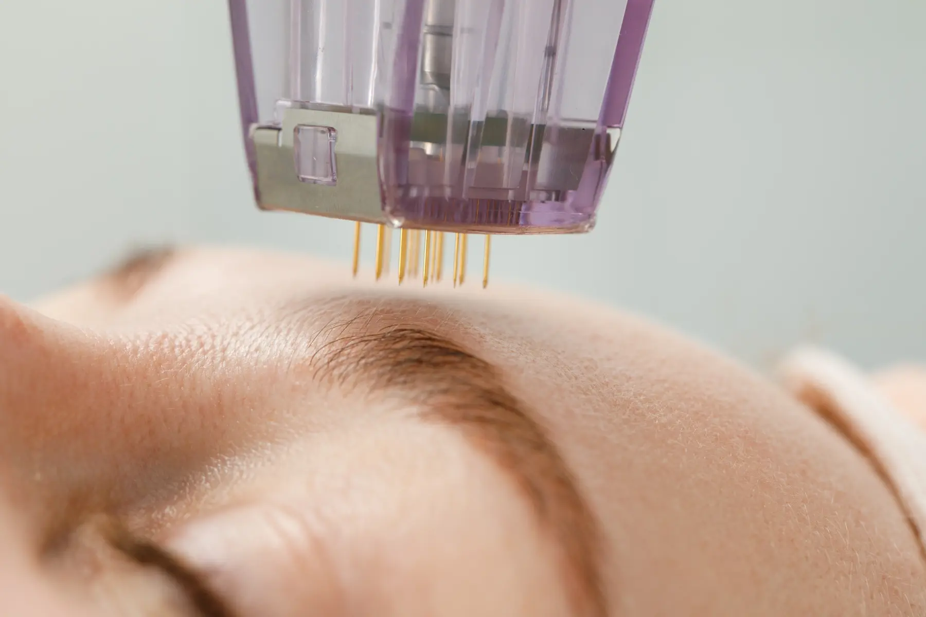 Microneedling von Kala Nui Wellness und Kosmetik