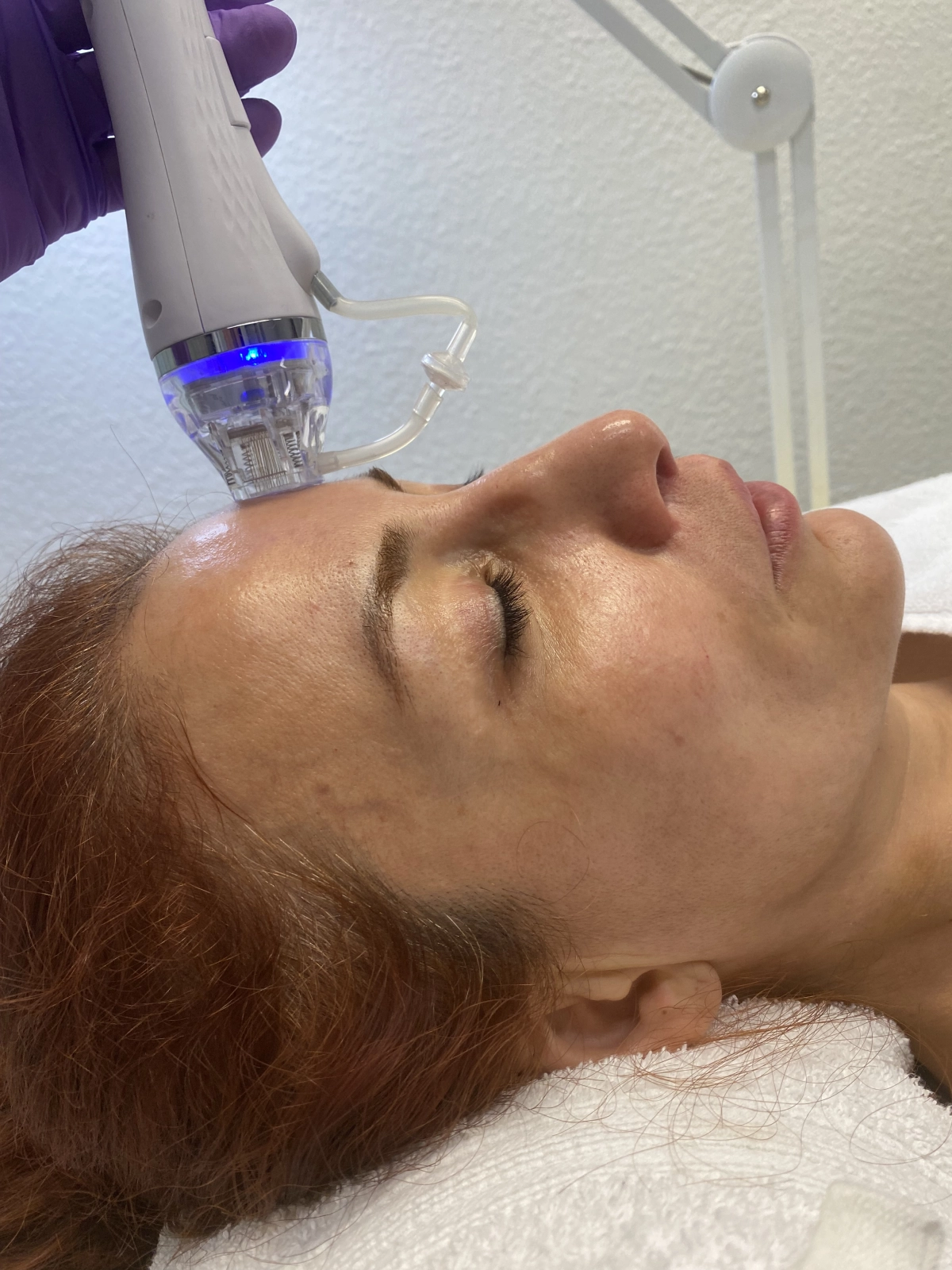 Microneedling von Kala Nui Wellness und Kosmetik